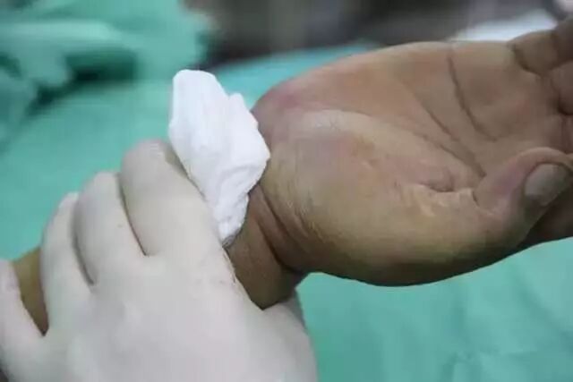 造影导丝是什么请看：这是心脏支架真实的样子_https://www.jmylbn.com_新闻资讯_第24张