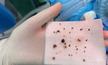 吃个火锅把自己吃进了医院，“真凶”竟是火锅底料