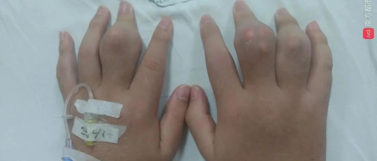 18岁小伙子手脚长“钻石”，他后悔：再也不喝奶茶了！