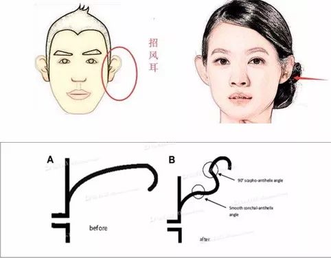 什么是招风耳 要不要手术矫正 整形外科任纪祯医生 微信公众号文章阅读 Wemp