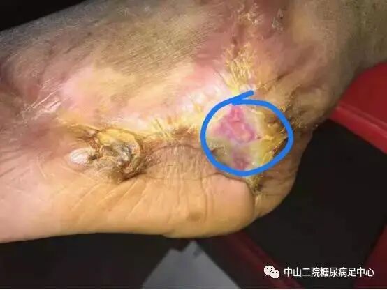 抗菌清创敷料怎么使用糖尿病足局部创面的抗菌治疗（十二）——糖尿病足创面应用碘伏换药的愈合过程及小结 ｜ 中心专辑_https://www.jmylbn.com_新闻资讯_第6张