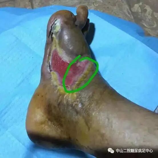 抗菌清创敷料怎么使用糖尿病足局部创面的抗菌治疗（十二）——糖尿病足创面应用碘伏换药的愈合过程及小结 ｜ 中心专辑_https://www.jmylbn.com_新闻资讯_第2张