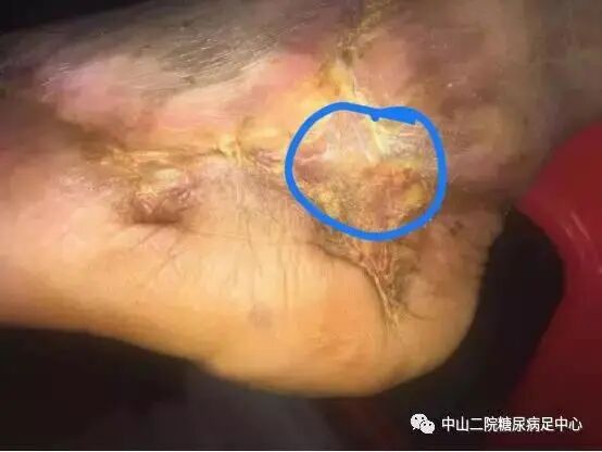 抗菌清创敷料怎么使用糖尿病足局部创面的抗菌治疗（十二）——糖尿病足创面应用碘伏换药的愈合过程及小结 ｜ 中心专辑_https://www.jmylbn.com_新闻资讯_第12张