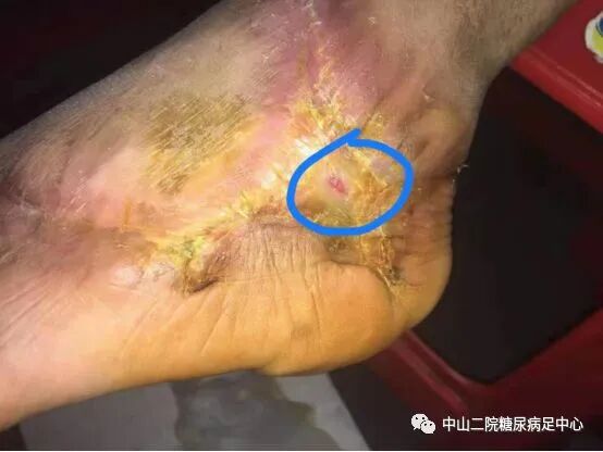抗菌清创敷料怎么使用糖尿病足局部创面的抗菌治疗（十二）——糖尿病足创面应用碘伏换药的愈合过程及小结 ｜ 中心专辑_https://www.jmylbn.com_新闻资讯_第8张