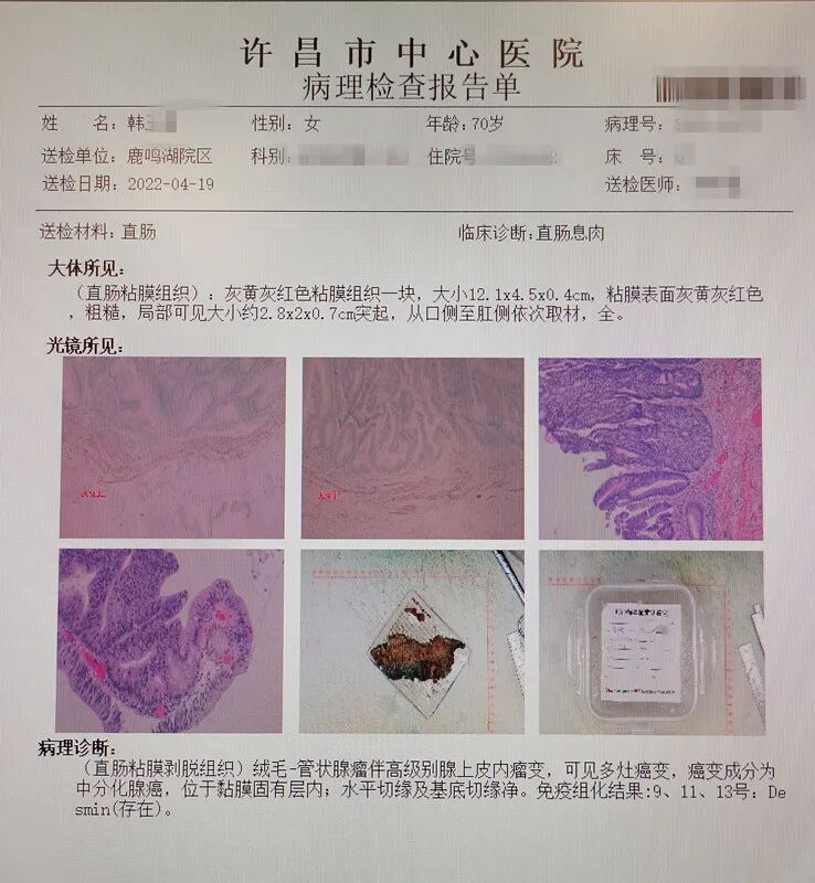 口镜怎么肛门口摸到软软的东西，以为是痔疮，没想到竟然是它…_https://www.jmylbn.com_新闻资讯_第18张