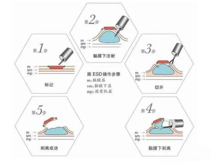口镜怎么肛门口摸到软软的东西，以为是痔疮，没想到竟然是它…_https://www.jmylbn.com_新闻资讯_第14张