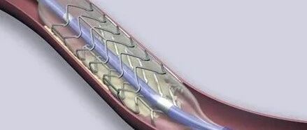 11月“科学”流言榜发布：心脏支架已被淘汰了？没这事