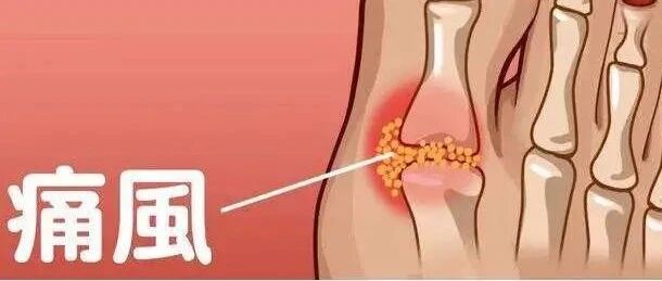 痛风那些事儿