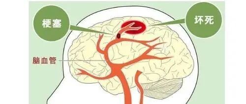 你了解重症脑梗死的病因和治疗吗？