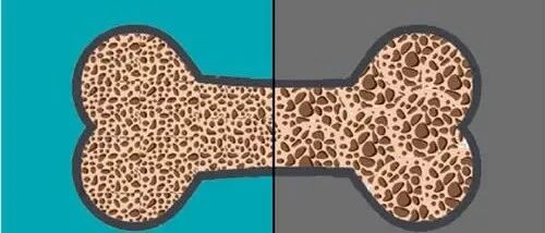 打个喷嚏就骨折，或是患有骨质疏松，10个问题帮您自测