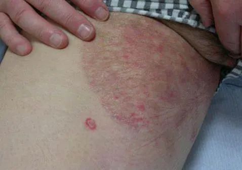 大腿内侧与阴囊两侧湿疹瘙痒潮湿发黑怎么治疗好
