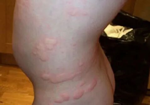 18种皮肤病图片识别