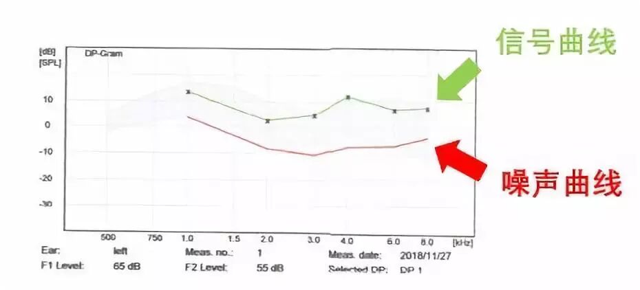 耳声发射图怎么看【上海九院专家帮听障宝妈支招（13）】教宝妈读懂听力检查报告单：耳声发射报告_https://www.jmylbn.com_新闻资讯_第8张