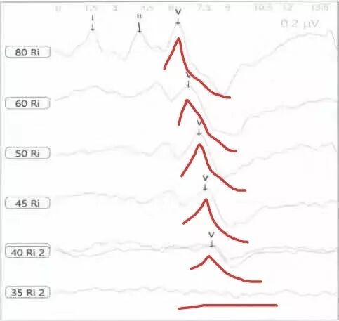 听性脑干反应检查是什么【上海九院专家帮听障宝妈支招（14）】教宝妈读懂听力检查报告单：听性脑干反应ABR报告_https://www.jmylbn.com_新闻资讯_第10张