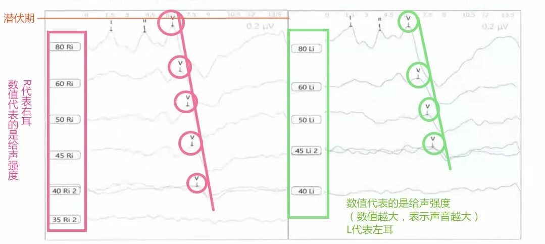听性脑干反应检查是什么【上海九院专家帮听障宝妈支招（14）】教宝妈读懂听力检查报告单：听性脑干反应ABR报告_https://www.jmylbn.com_新闻资讯_第9张