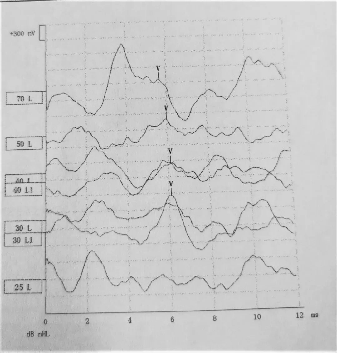 听性脑干反应检查是什么【上海九院专家帮听障宝妈支招（14）】教宝妈读懂听力检查报告单：听性脑干反应ABR报告_https://www.jmylbn.com_新闻资讯_第11张