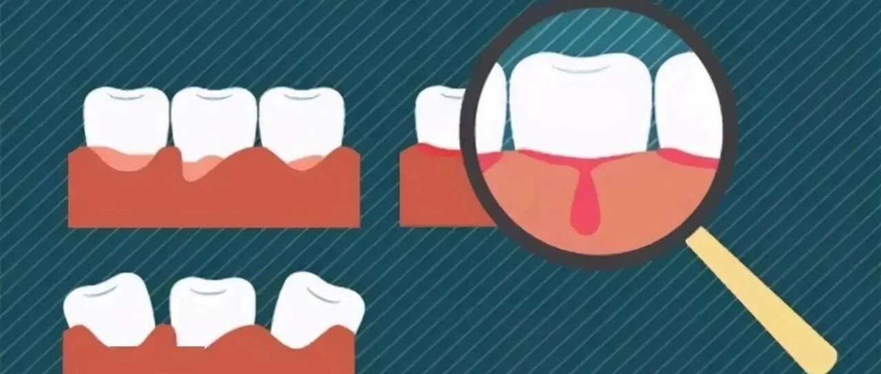 【疾病判断】总是牙龈出血，是得了血液病吗？