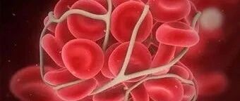 血小板增多症是什么？一文读懂血小板增多