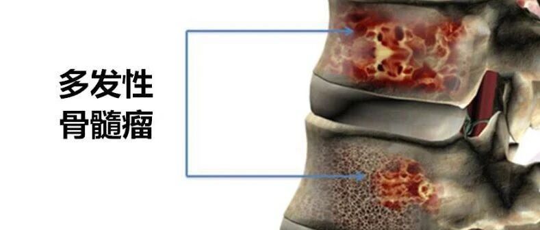 骨髓瘤患者白细胞低下，预防感染应做到5点！