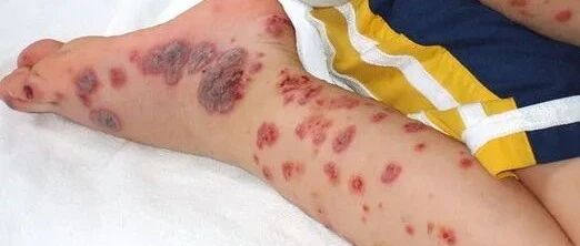 血小板减少会变为白血病吗？