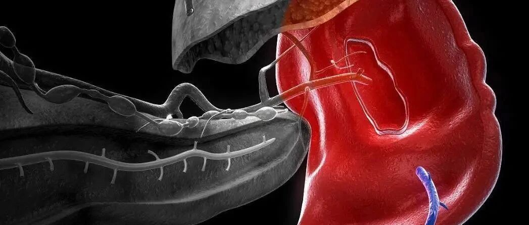 骨髓纤维化“脾大”是不是一定要切脾？