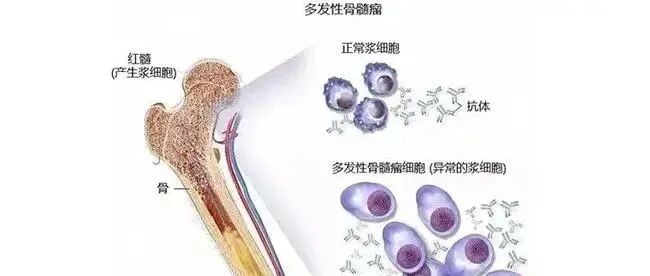 【患者须知】骨髓瘤复发后有哪些症状？平时要注意什么？