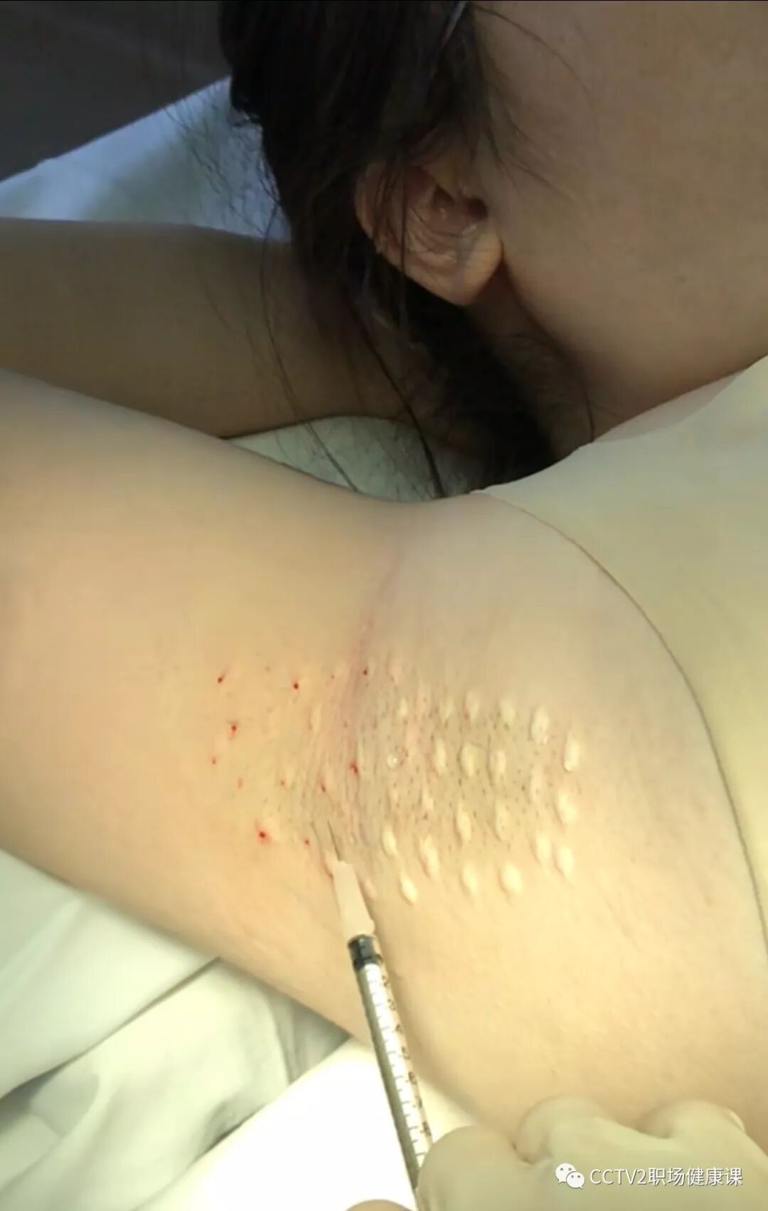 腋下出汗多 有臭味,教你几招赶走夏季"尴尬癌" - 好大夫在线