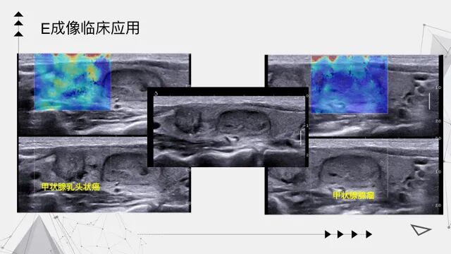 乳腺触诊成像怎么看我院跨入超声成像“E时代”——E超实现病灶的“声触诊”_https://www.jmylbn.com_新闻资讯_第7张