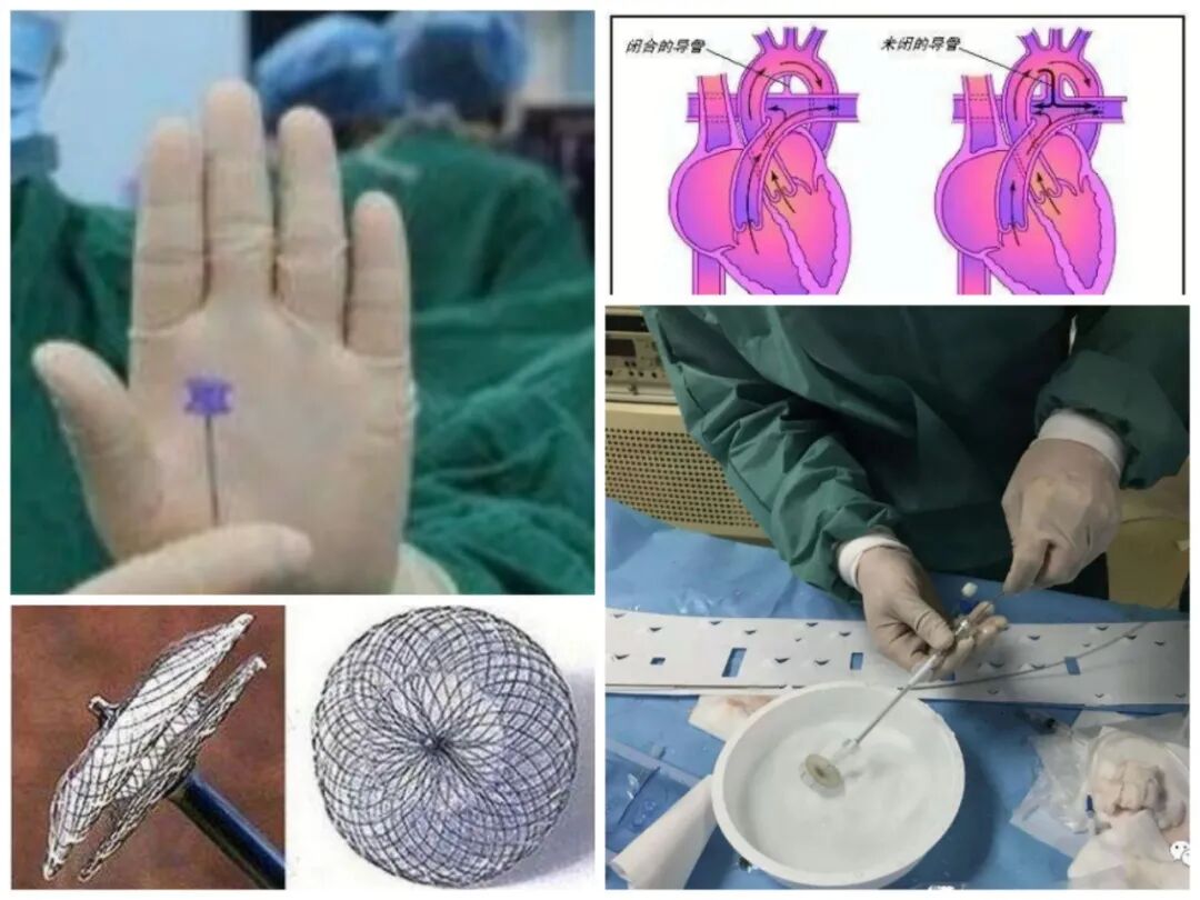 我院龙湾院区心血管内科介入成功实施动脉导管未闭介入封堵术