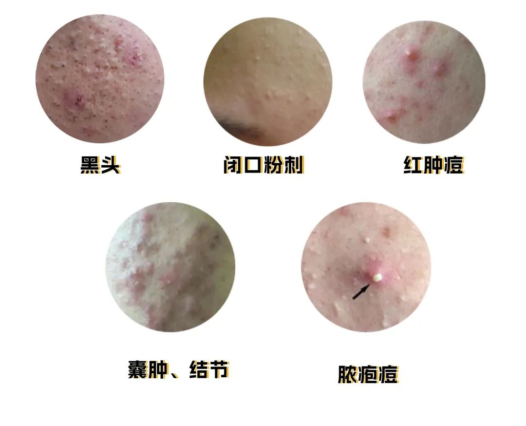 脸上长火疖子黑头闭口怎么办