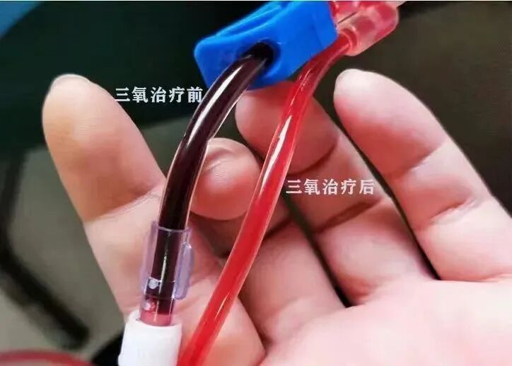 什么是臭氧大自血疗法健康科普丨以己之血 治己之病——大自血（臭氧）疗法_https://www.jmylbn.com_新闻资讯_第7张