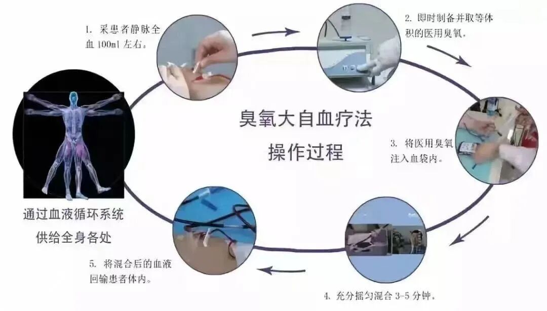 什么是臭氧大自血疗法健康科普丨以己之血 治己之病——大自血（臭氧）疗法_https://www.jmylbn.com_新闻资讯_第5张