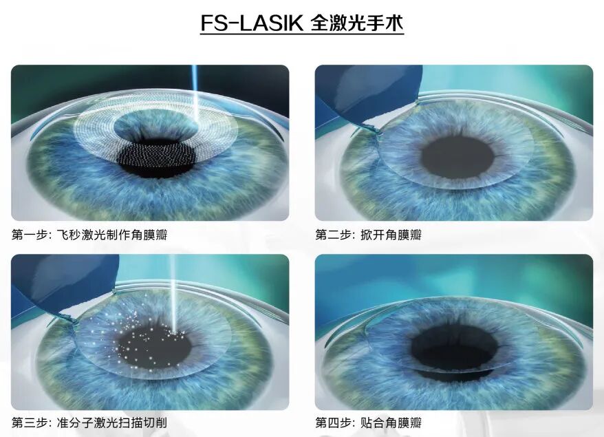 FS-Lasik.jpg