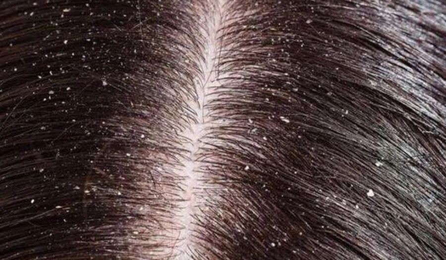 头皮癣是否可以自愈？