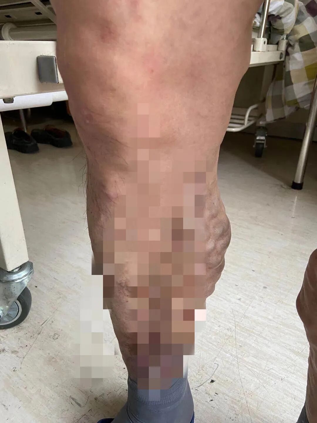 男子腿上多处长 蚯蚓 几十年没穿过短裤 楚天都市报 微信公众号文章阅读 Wemp