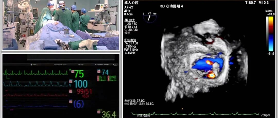 国内首例｜安贞医院张海波教授团队应用Memoclip二尖瓣夹修复系统植入双夹子，攻克超大二尖瓣反流