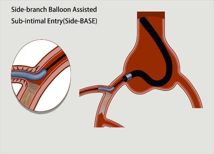导丝怎么扩秦川论剑｜张勇：攻坚克难——解决器械难以通过的CTO病变之技术图谱_https://www.jmylbn.com_新闻资讯_第8张