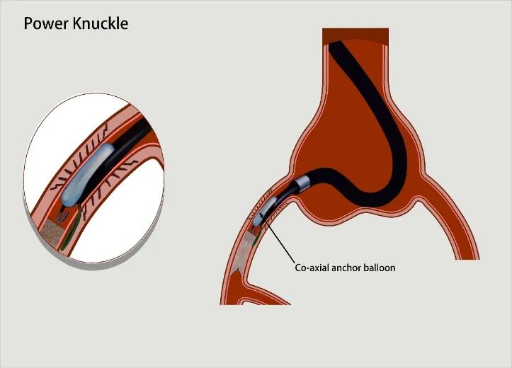 导丝怎么扩秦川论剑｜张勇：攻坚克难——解决器械难以通过的CTO病变之技术图谱_https://www.jmylbn.com_新闻资讯_第6张