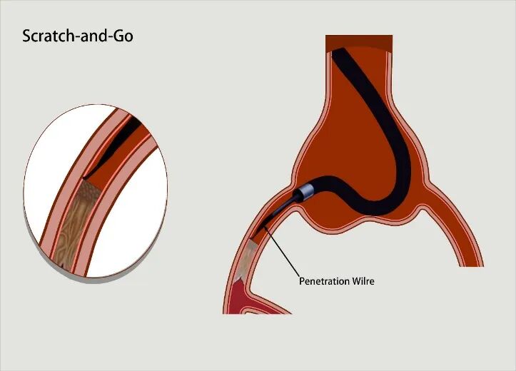 导丝怎么扩秦川论剑｜张勇：攻坚克难——解决器械难以通过的CTO病变之技术图谱_https://www.jmylbn.com_新闻资讯_第4张