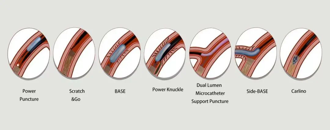 导丝怎么扩秦川论剑｜张勇：攻坚克难——解决器械难以通过的CTO病变之技术图谱_https://www.jmylbn.com_新闻资讯_第2张