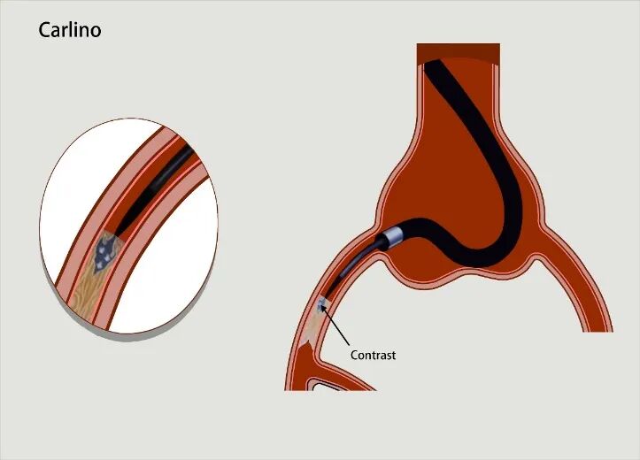 导丝怎么扩秦川论剑｜张勇：攻坚克难——解决器械难以通过的CTO病变之技术图谱_https://www.jmylbn.com_新闻资讯_第9张