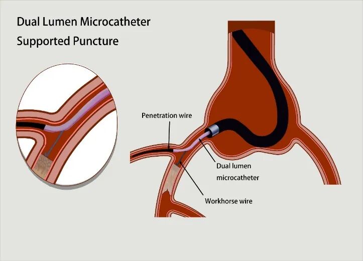 导丝怎么扩秦川论剑｜张勇：攻坚克难——解决器械难以通过的CTO病变之技术图谱_https://www.jmylbn.com_新闻资讯_第7张