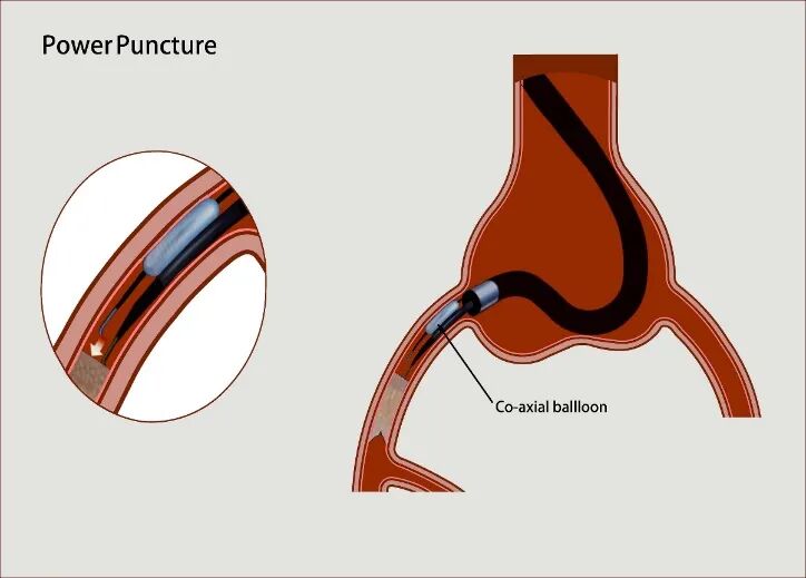 导丝怎么扩秦川论剑｜张勇：攻坚克难——解决器械难以通过的CTO病变之技术图谱_https://www.jmylbn.com_新闻资讯_第3张
