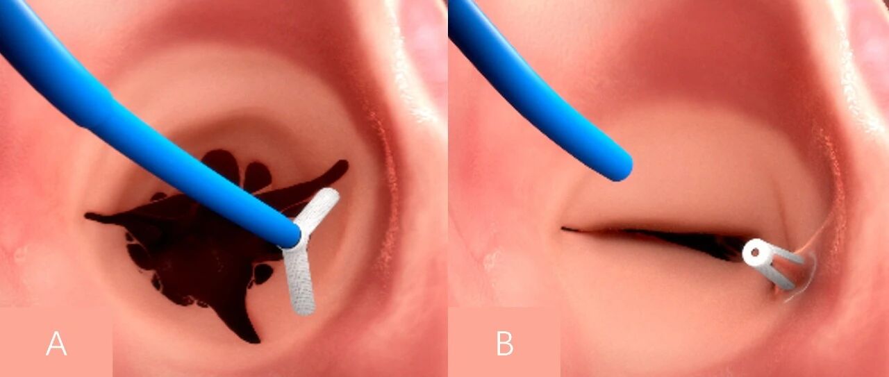 早期临床数据喜人！研究者发布K-Clip可行性临床研究结果