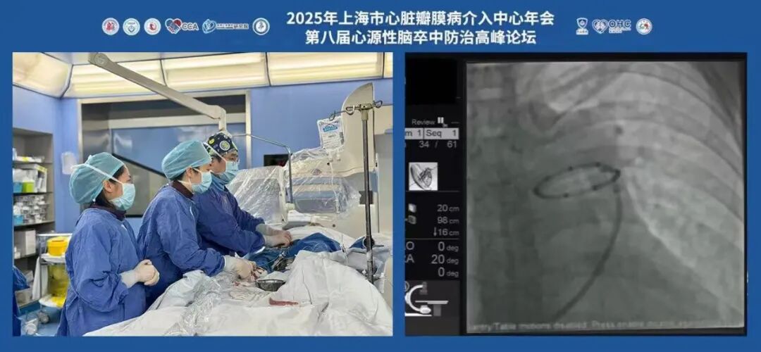 pa导管是什么精准消融，行云流水丨葛均波院士团队圆满完成一例PADN手术演示，推动中国原创疗法广泛应用-上海聚慕医疗器械有限公司