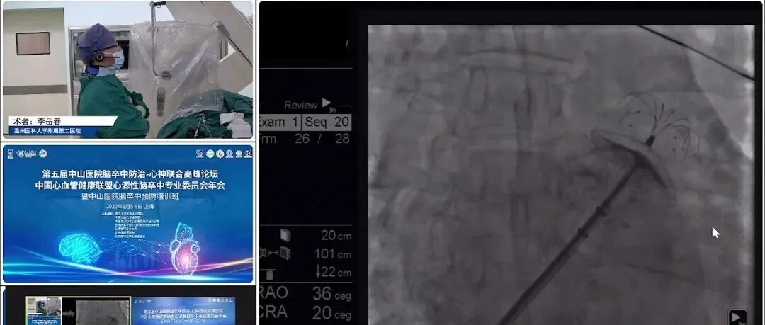 2021年温医大附二院左心耳封堵手术量再攀“心”高峰