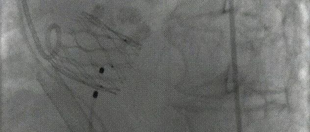 北京安贞医院张海波团队完成首例体外循环辅助下SinoCrown™完全可回收瓣膜的冠脉高风险重症TAVR病例