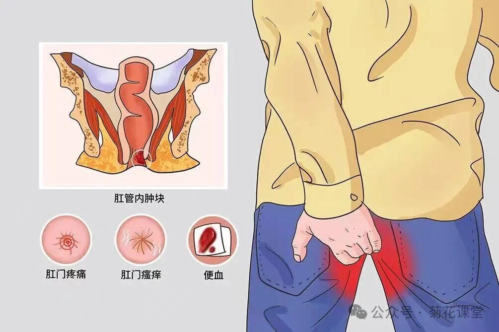 别忽视肛门周围的 “小异常”！