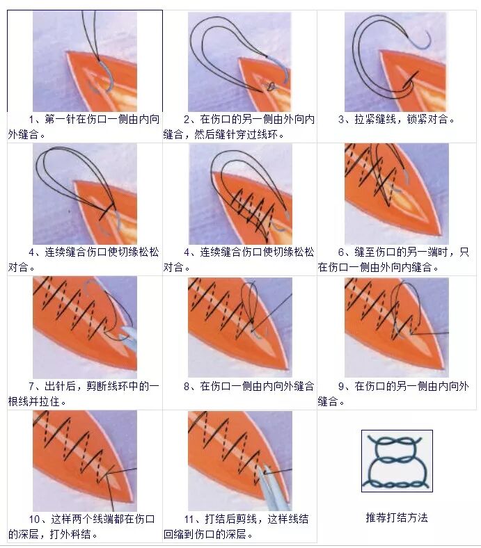 可吸收缝合线怎么吸收强生缝合线可吸收缝合线 综合对比介绍_https://www.jmylbn.com_新闻资讯_第4张
