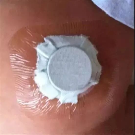 新生儿肚脐夹怎么打开婴儿肚脐凸出来要用带子、硬币压吗？宝宝脐疝像这样护理最靠谱_https://www.jmylbn.com_新闻资讯_第6张